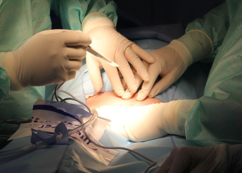 Everything You Should Know About Tummy Tucks